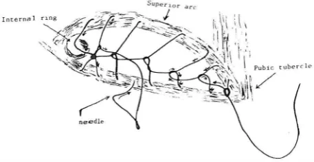 Fig. 5. The axis of the 2nd layer makes a 45° angle with the axis of the first layer of sutures