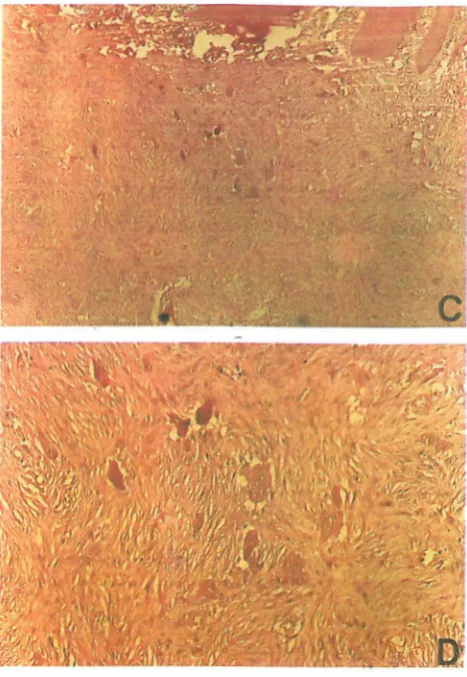 Fig. 3. connective tissue stroma, with numerous fibroblasts and scattered High power magnification giant cells Immediate postoperative view of the patient (A)