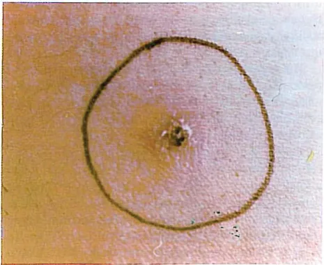 Fig. 4. Tinea pedis due to T. rubrunl. 