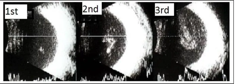Figure 1: Three degrees of vitreous opacities ultrasonography: Left = 1st; Center= 2nd; Right = 3rd  3