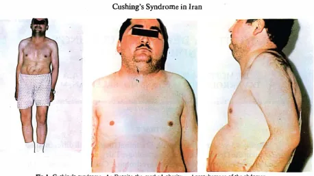 FIg 1. Cushing's syndrome. A: Despite the marked obesity and protuberance of the abdomen, the extremities arc thin