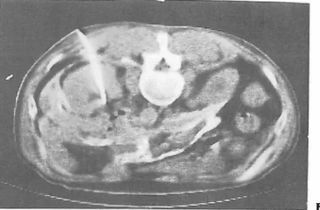 Figure 3. with rectal carcinoma. Prone CT-scan obtained for demonstrating anatomic detail and localization of puncture site