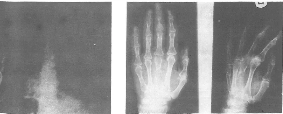 Fig. I. Chest roentgenogram reveals generalized osteoporosis. 