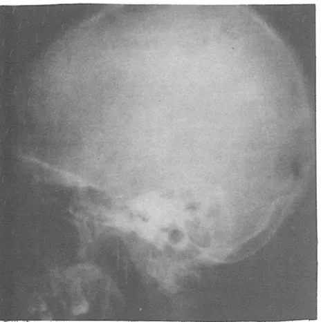 Fig. 5. Bone biopsy under higher magnification. 