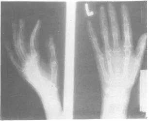 Fig. 7. Chest X-ray revealing osteoporosis. 