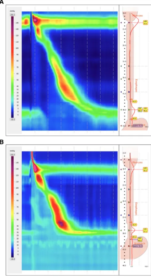 Figure 1 (A) A high-resolution manometry with pressure topography demonstrating the absence of a hiatal hernia with near overlap of the lower oesophageal sphincter and crural diaphragm