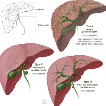 Figure 1 Proposal of a classification framework for peribiliary cysts. When the hepatic bile duct bifurcation delineates two hepatobiliary segments: hepatic and extrahepatic, we identify the following types: type I: hepatic, type II: extrahepatic, type III: mixed hepatic and extrahepatic.