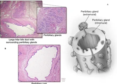 Figure 2 (A) Schematic representation of peribiliary glands, and histology. (B) Histology of a peribiliary cyst.