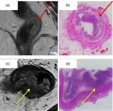 Figure 1(A) Submucosa has a hyperintense signal on MRI (red arrow) which should be considered partially or fully preservedif at least 1 mm visible on high-resolution T2-WI