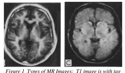 Figure 1  Types of MR Images:  T1 image is with tag B, T2 image with tag C. Extracted from [2] to show that white matter and gray matter are more distinct in T1 as compare to T2 