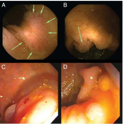 Table 2Percentage of studies with adequate bowelcleansing level by colon segment