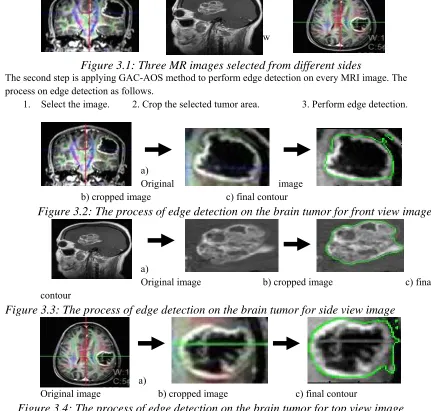 Figure 3.3: The process of edge detection on the brain tumor for side view image  