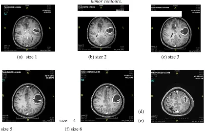 Figure 3.6: Demonstration chart to compute the VE for (a) two brain tumor contours; (b) three brain tumor contours