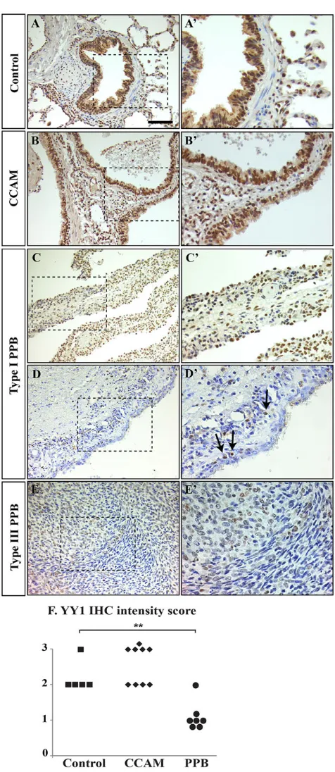 Fig. 7. YY1 expression in congenital cystic lung diseases. YY1 proteinexpression in lungs from control patients (A) or suffering from type I CCAM (B),type I PPB (C,D) and type III PPB (E)