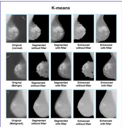 Figure 1.  Figure 2: Peripheral enhancement by using the K-means 