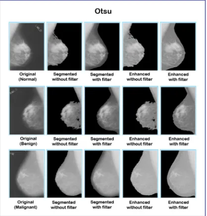 Figure 3: Peripheral enhancement by using the Otsu method 