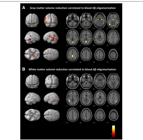 Fig. 2 Grey matter (a) and white matter (b) volume reduction correlated with Aβ oligomerization measured with MDS-OAβ (n = 162, correctedfor age and total intracranial volume, family-wise error (FWE) < 0.05)