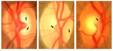 Figure 3. Artefacts On The Optic Disk Mas In Retinal Images. 