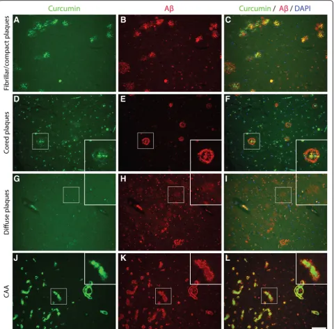 Fig. 2 Co-labelling using curcumin and anti-amyloid beta (Aβ) in Alzheimer brains. Curcumin co-labelling with anti-amyloid-beta using IC-16 inAlzheimer brains (hippocampus (a-c), temporal cortex(d-i), occipital cortex(j-l)) to show overlap and differences