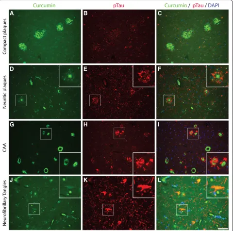 Fig. 3 Co-labelling using curcumin and anti-phosphorylated Tau in Alzheimer brains. Curcumin co-labelling with anti-phosphorylated tau using100AT8 in Alzheimer brains (hippocampus(a-c), temporal cortex(d-f and j-l), occipital cortex(g-i)) to show overlap a