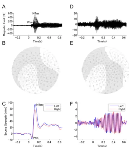 Figure 1Representative single subject resultsRepresentative single subject results. (A) Overlay of individual magnetic field waveforms of all channels (30 Hz low-pass filtered)
