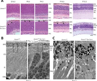 Fig. 2. Thin retinal layers and absence ofphotoreceptor outer segments in