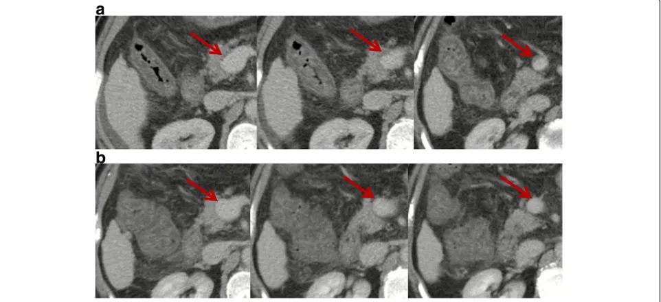 Fig. 1 Contrast-enhanced computed tomography scans in a patient with transient PVT. Contrast-enhanced computed tomography performed inFebruary 2017 demonstrated mild ascites, patent intrahepatic portal vein branches and splenic vein, mild thrombosis within