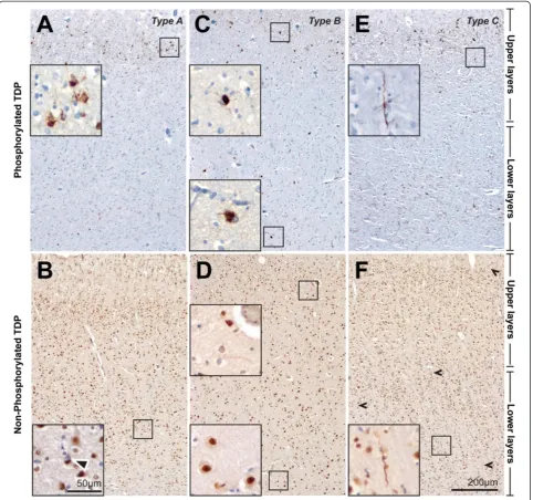 Figure 3 Laminar distribution of pathological TDP43 lesions in sections of the same cases immunostained with pTDP43 (A, C, E) and(Patient #10) was also obvious on sections with pTDP43immunostained with pTDP43iTDP43 (B, D, F)