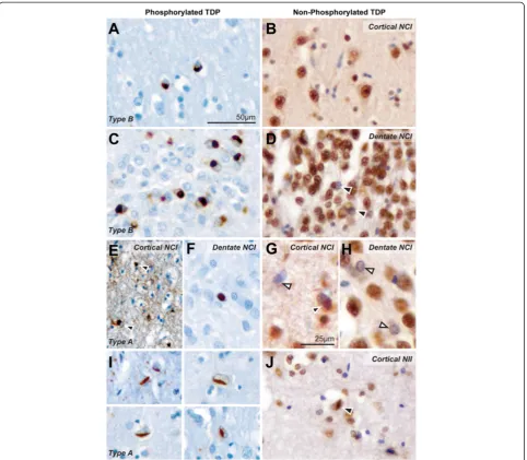 Figure 4 Pathological inclusions identified in similar sections of the same cases examined with pTDP43 and iTDP43