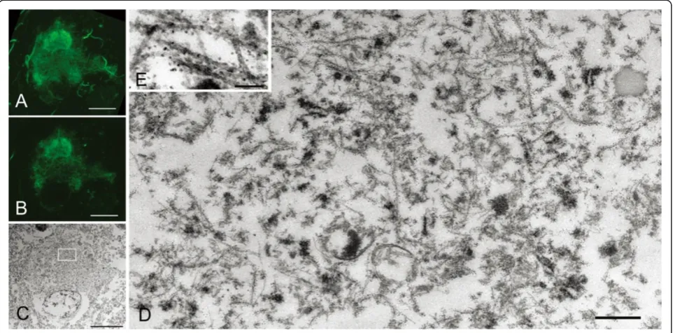 Figure 5 Correlation of immunolabeled LM and EM images of pretangles in a severe case of CBD.(B, C)straight filaments were thicker with a diameter of 15 In a pretangle neuron from a severecase of CBD (case 4), reticular tau immunoreactivity was denser on 3