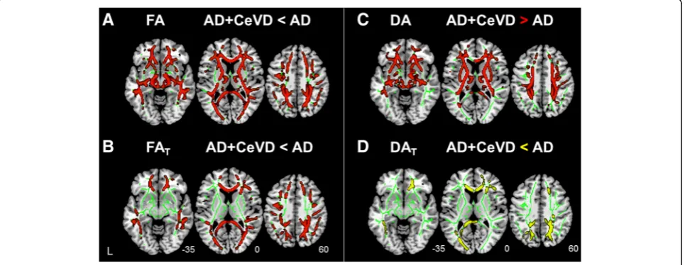 Fig. 2 Free water (FW) increases are associated with dementia severity. a There was no association between white matter hyperintensity (WMH)and Clinical Dementia Rating Sum of Boxes (CDR-SB) score