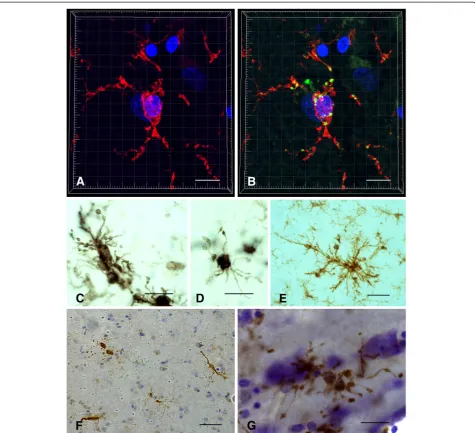 Figure 2 Dystrophic microglia have many guises and can be stained with different antibodies