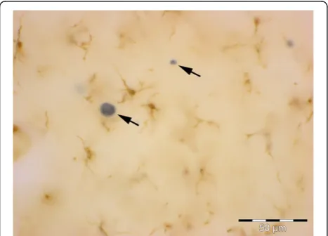 Figure 6 Widespread dystrophy and absence of brainmacrophages are evident in Down syndrome brain