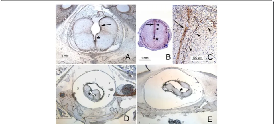 Figure 1 Syrinx morphology in Chiari II malformations. A Type 1 syrinx: the ventral portion of the cavity is ependymal lined (asterix), whilethe dorsal aspect is irregularly lined by a layer of hyperplastic glia (arrow)