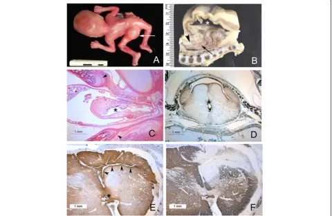 Figure 3 Spinal cord and syrinx pathology in OEIS. Acentral canal of the spinal cord (arrow) which herniates dorsally