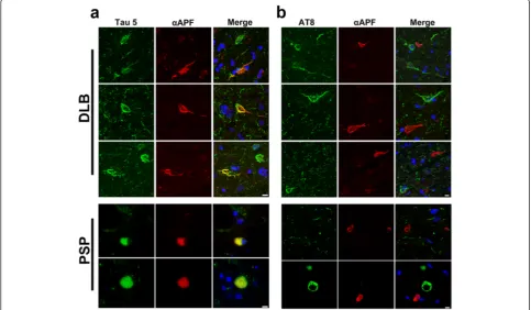 Figure 3 Tau APFs are not phosphorylated at Ser202/Thr205. (a) Tau APFs were examined after double immunofluorescence labeling usingTau-5 (green) and αAPF (red) in DLB and PSP sections