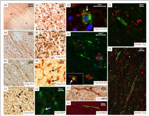 Figure 4 Cell associated C1q complement staining.centre of an active plaque.HLA-DR (brown) confirms C1q immunopositive debris located within HLA positive foamy macrophages cells; (case MS160_S3, active plaque).with anti-C1q in plaque (P) and peri-plaque (P