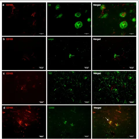 Figure 6 Double immunofluorescence detection of CD163 with ACD163 (red) and tau (green) in the hippocampus of an AD case