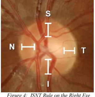 Figure 4:  ISNT Rule on the Right Eye 