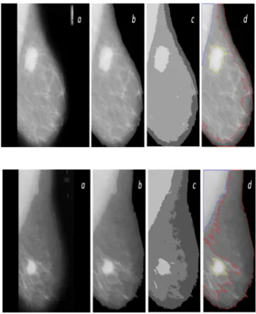 Figure 4: Separation of breast profile region from 
