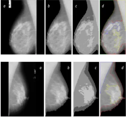 Figure 6: Segmentation and detection the boundary of different breast tissue regions of mdb019 and mdb120: (a) Original image, (b) Mammography image after preprocessing step, (c) Detect the different breast tissue regions by using kmeans algorithm, (d) Segment and detect the boundary of different breast tissue regions by 