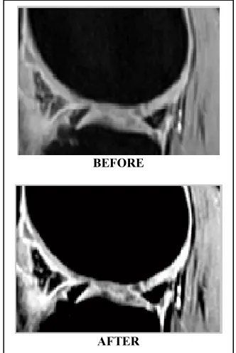 Figure 12: Gray Scale Adjustment of Knee MR Images 