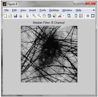 Figure 3: Median Filtering on G Channel of the image 