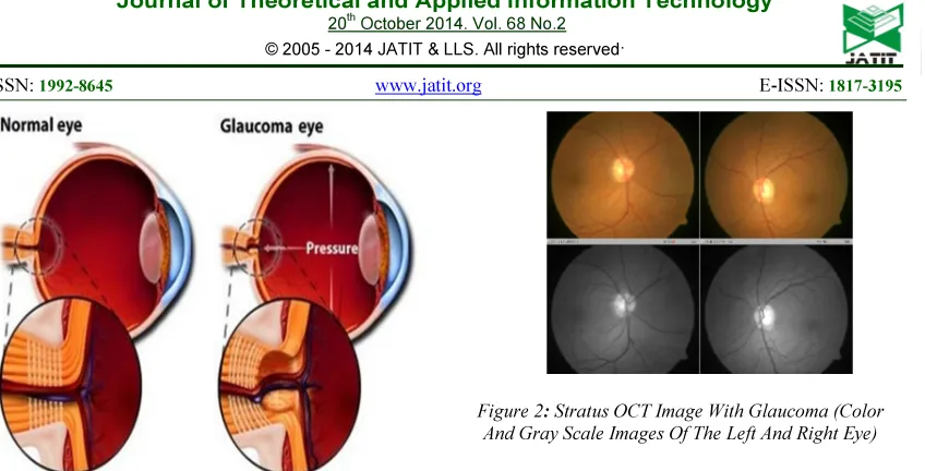 Figure 2: Stratus OCT Image With Glaucoma (Color And Gray Scale Images Of The Left And Right Eye) 
