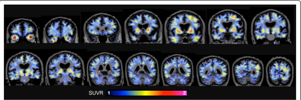 Fig. 1 Coronal in vivo [F-18]-AV-1451 PET images of the PD subject. The color scale indicates SUVR range from 1 to 2