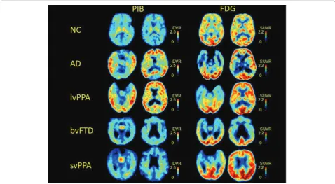 Figure 1. Amyloid tracer binding. Typical patterns in normal controls (NC), Alzheimer’s disease (AD), logopenic variant of primary progressive aphasia (lvPPA), behavioral variant frontotemporal dementia (bvFTD), and semantic variant of primary progressive 