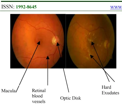 Figure 1 Normal Retina and DR affected retina 