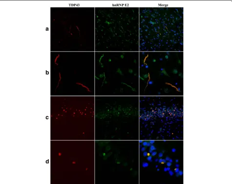 Fig. 2 Immunofluorescence for TDP43 (red) and hnRNP E2 (green) in the temporal cortex (a,b) and dentate gyrus of the hippocampus (c,d) ofFTLD cases