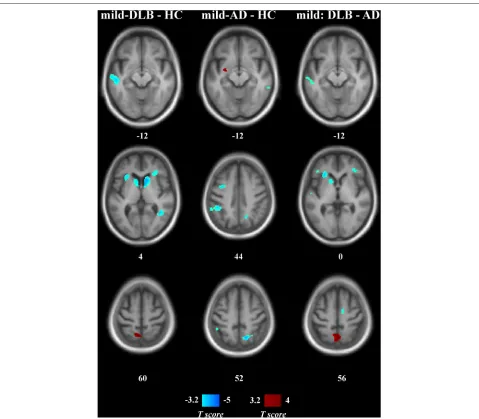 Fig. 2 Statistical maps of relative perfusion in patients with mild dementia and healthy controls