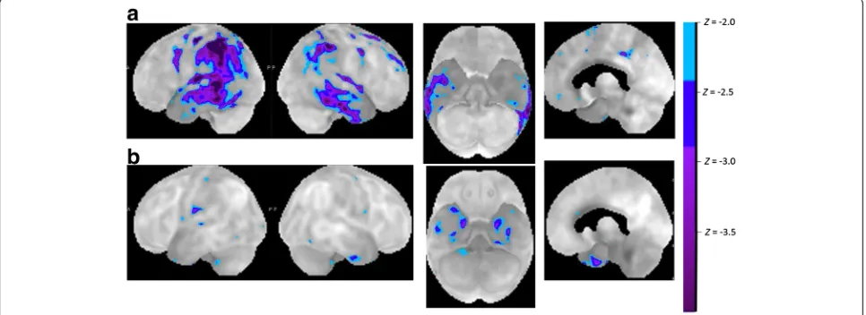 Fig. 2 Metabolic patterns in LV.The Z maps are calculated by comparing the individual glucose metabolic pattern to the normal age-matched control database using commercial a Patient with LV PPA and a pattern characteristic of left hemisphere-dominant Alzhe